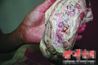 甲狀腺未摘除干凈的“雨潤問題肉” 甲狀腺未摘除干凈的“雨潤問題肉”