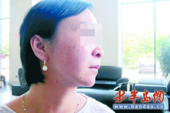 徐女士的臉上經過祛斑美容后,反倒長了不少小痘痘。 徐女士的臉上經過祛斑美容后,反倒長了不少小痘痘。