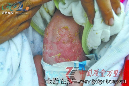 脫皮的嬰兒。(圖片來源:金黔在線)